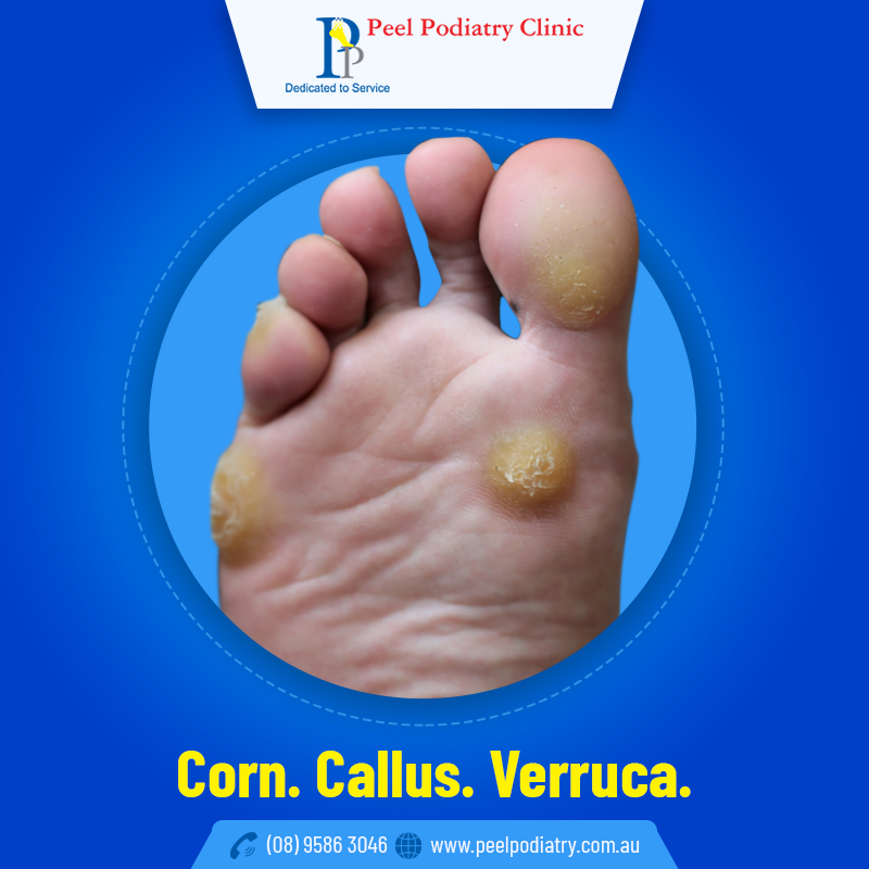 Corn, Callus or Verruca- Which One is Causing Pain on my Foot