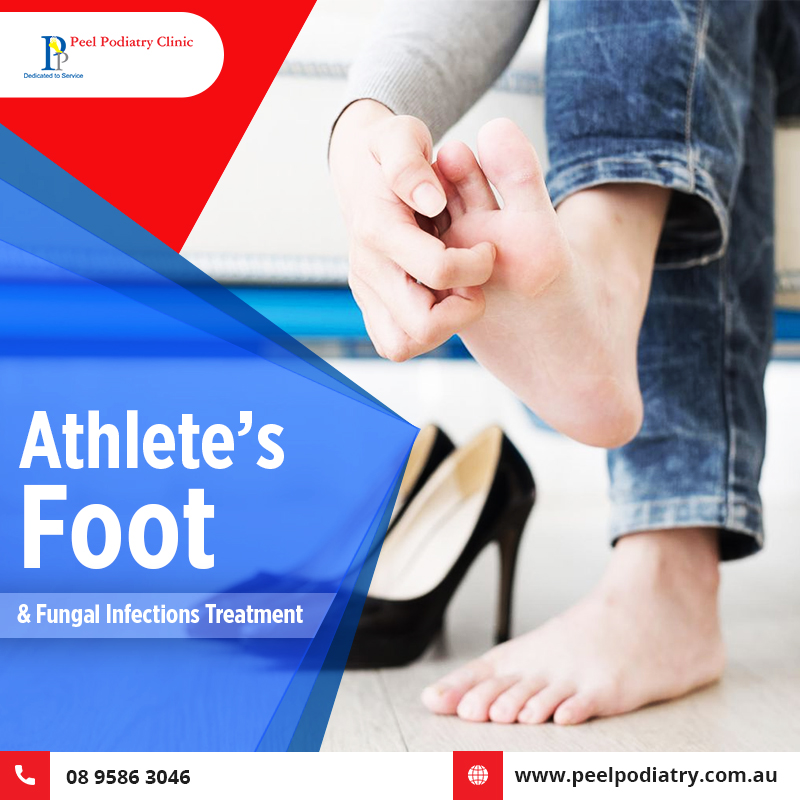 What is Athlete’s Foot & Do I Need a Fungal Infections Treatment