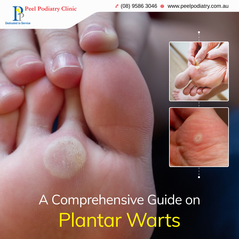 Everything You Need to Know About Plantar Warts