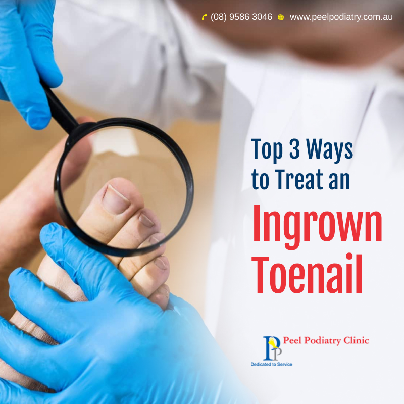 What Are the Best Ways to Treat an Ingrown Toenail?