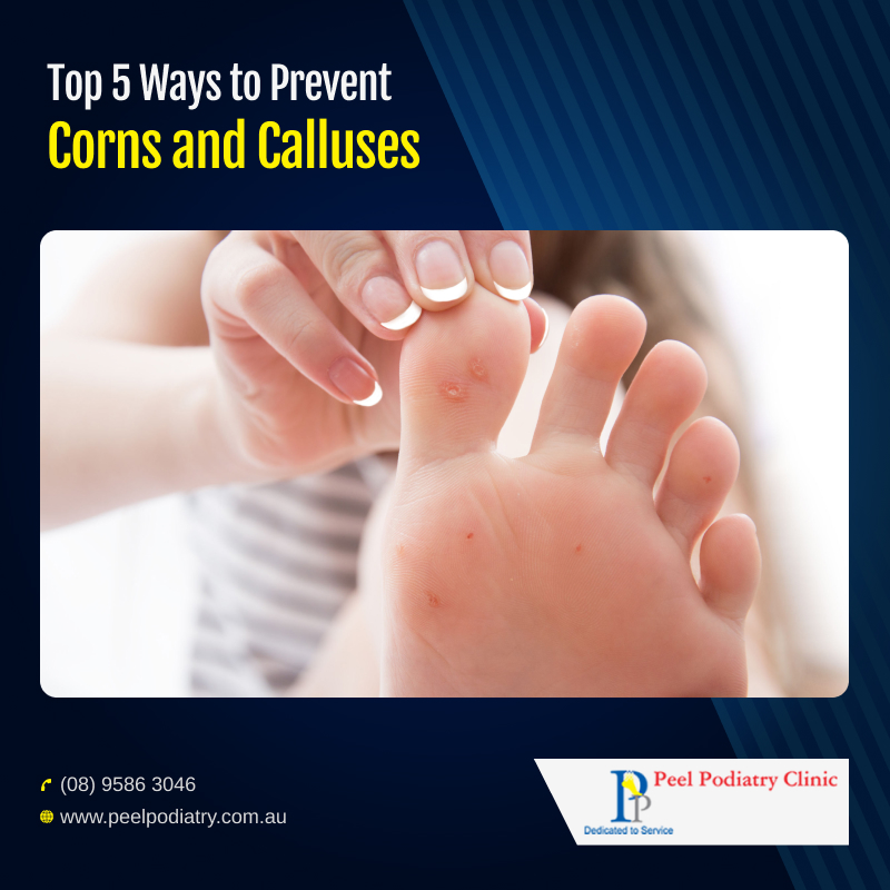 What Are the Best Ways to Prevent Corns and Calluses?