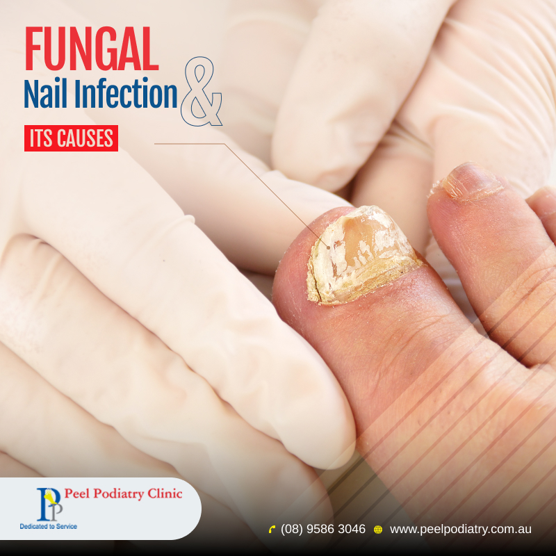 Fungal Nail Infection & Their Causes